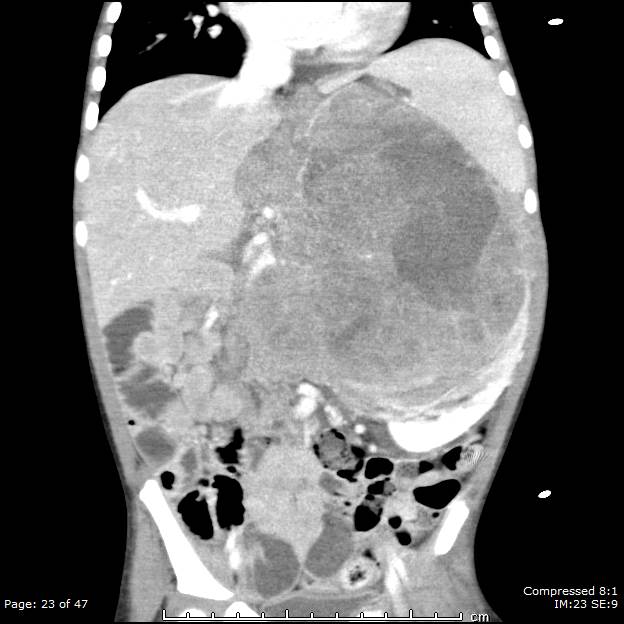 Neuroblastoma | Image | Radiopaedia.org