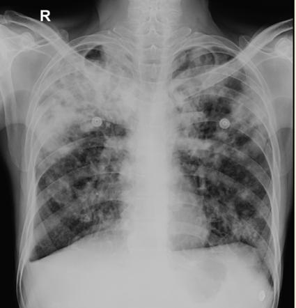 Pulmonary tuberculosis | Radiology Case | Radiopaedia.org