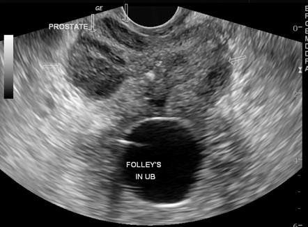 Prostatic abscess | Radiology Case | Radiopaedia.org