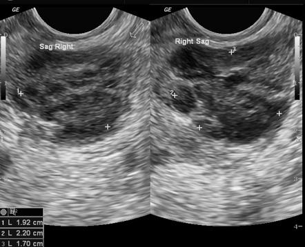 Prostatic abscess | Radiology Reference Article | Radiopaedia.org