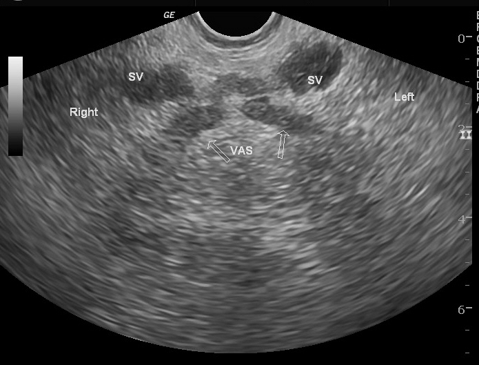 Prostatic abscess | Image | Radiopaedia.org