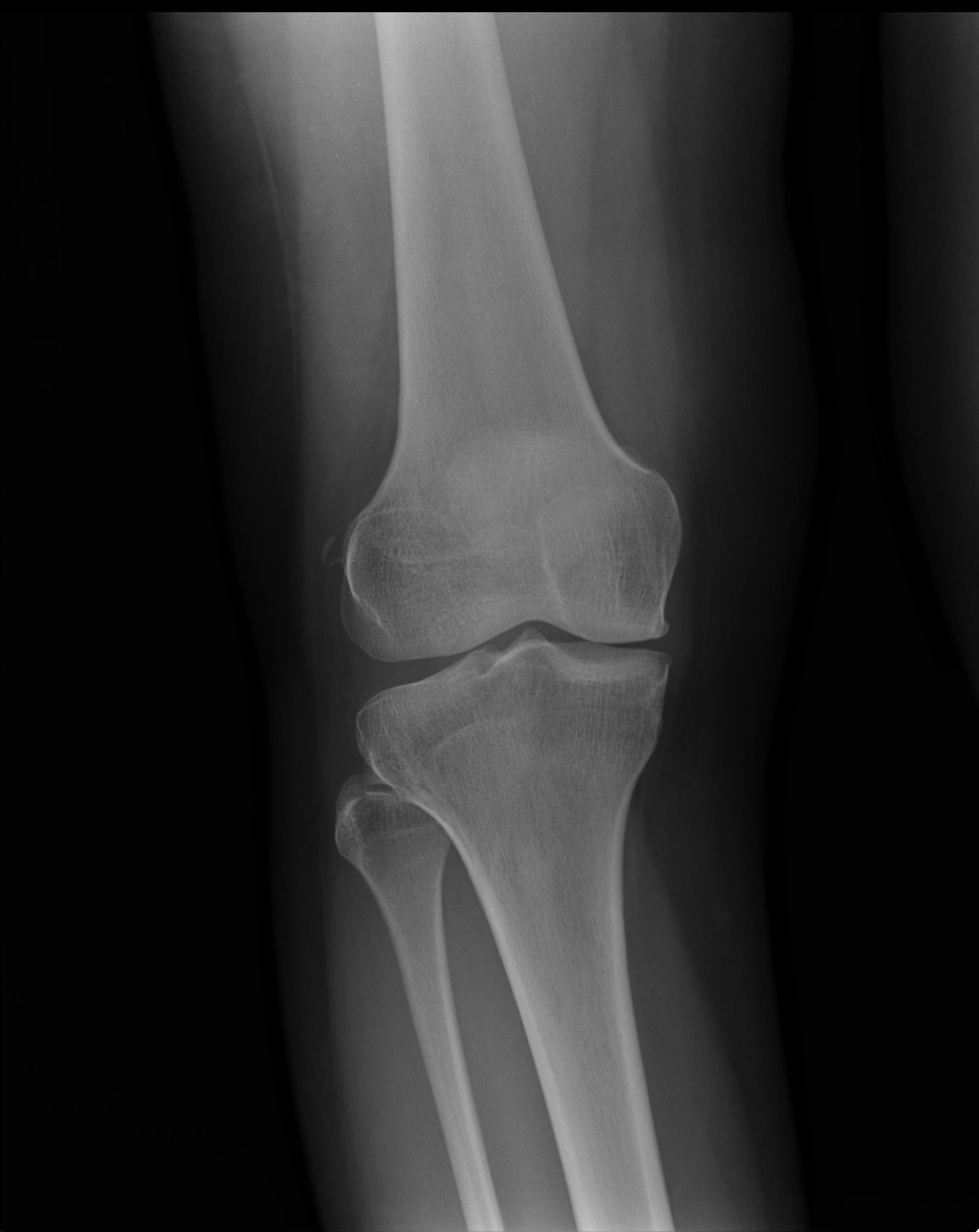 X Ray Knee Injury