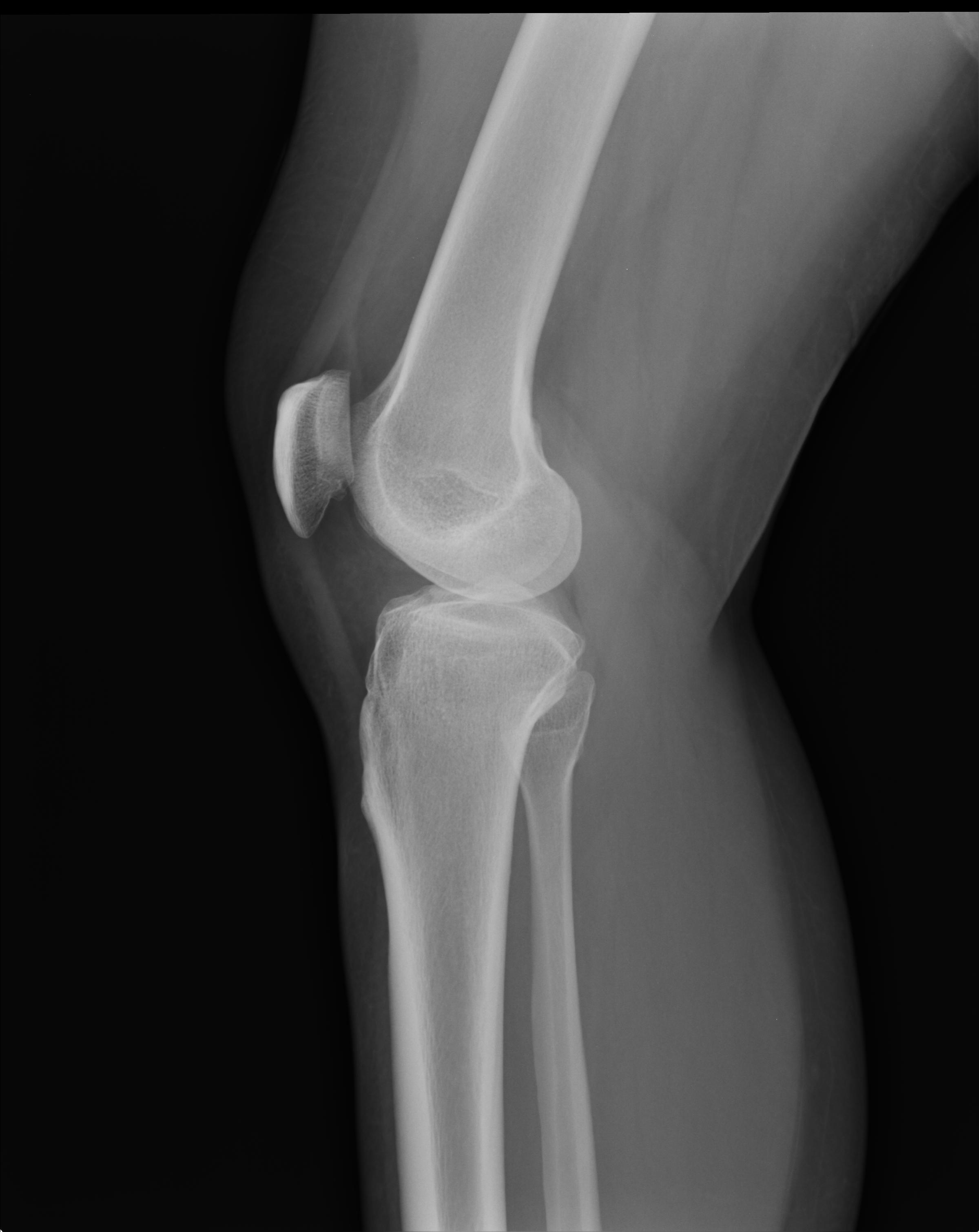 Lateral collateral ligament calcification - knee | Image | Radiopaedia.org