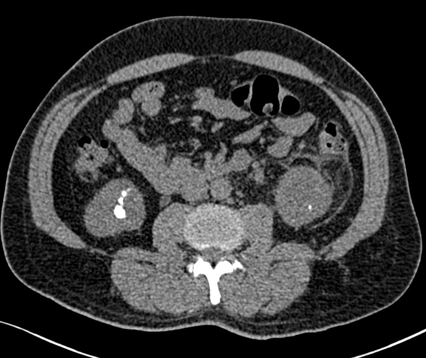 File:Pyonephrosis, stones and intervention (Radiopaedia 21111-21022 ...