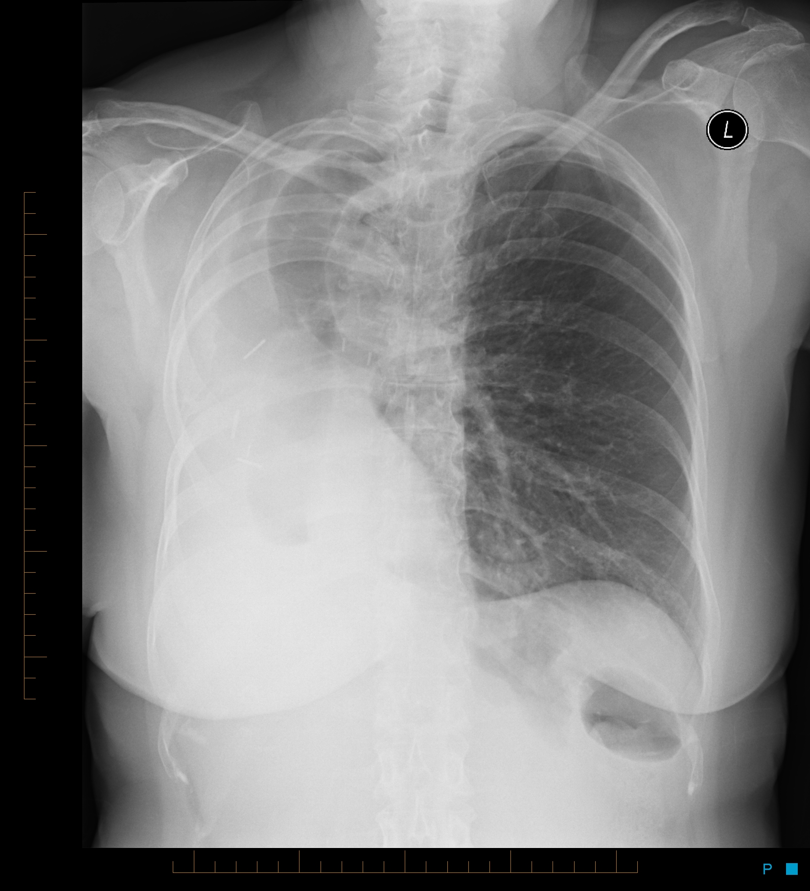 Chest Radiograph Wikidata