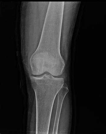 Lipohemarthrosis | Image | Radiopaedia.org