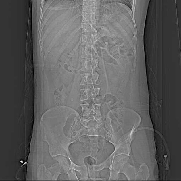 Featured image of post Acute Appendicitis Radiopaedia The cause of acute appendicitis is still unclear