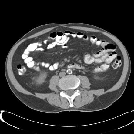 Appendiceal Abscesses 