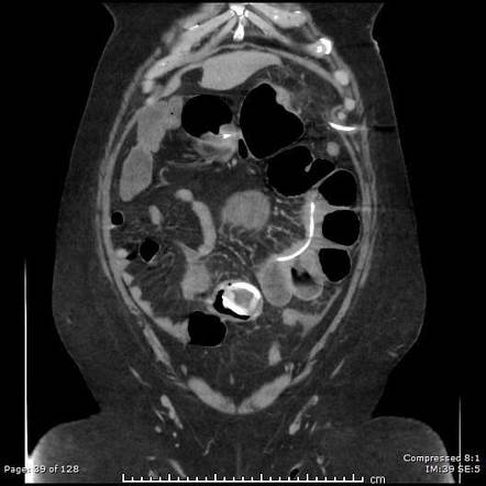 Gastric band erosion | Radiology Reference Article | Radiopaedia.org