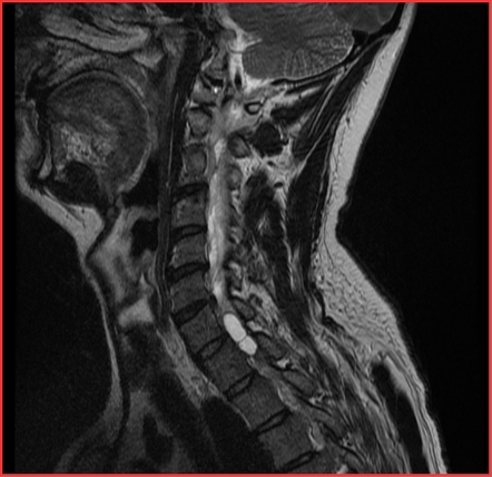 Spinal hydatid disease | Image | Radiopaedia.org