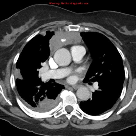 Thymic epithelial tumours | Radiology Reference Article | Radiopaedia.org