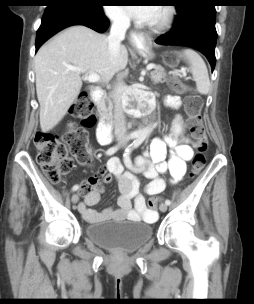 Paraganglioma - organ of Zuckerkandl | Image | Radiopaedia.org