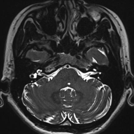 Abducens nerve palsy | Image | Radiopaedia.org