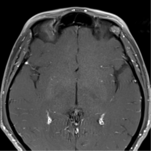 Abducens Nerve Palsy Image