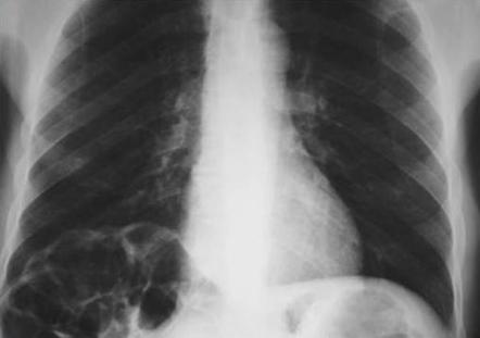 Pseudopneumoperitoneum | Radiology Reference Article | Radiopaedia.org