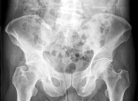 Central fracture-dislocation of the acetabulum | Radiology Case ...