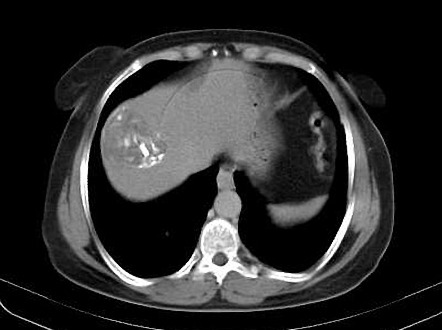 Calcified hydatid cyst of the liver | Image | Radiopaedia.org