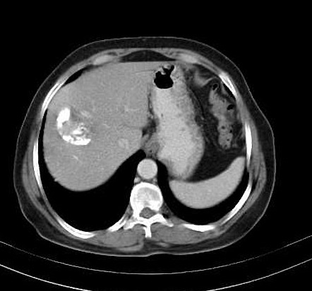 Calcified hydatid cyst of the liver | Radiology Case | Radiopaedia.org