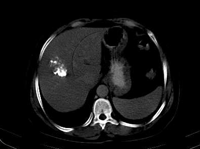 Calcified hydatid cyst of the liver | Image | Radiopaedia.org