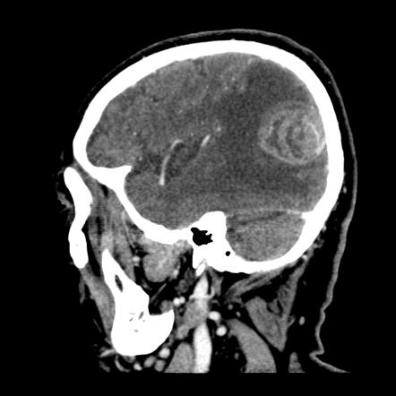 glioblastoma radiopaedia delayed sagittal