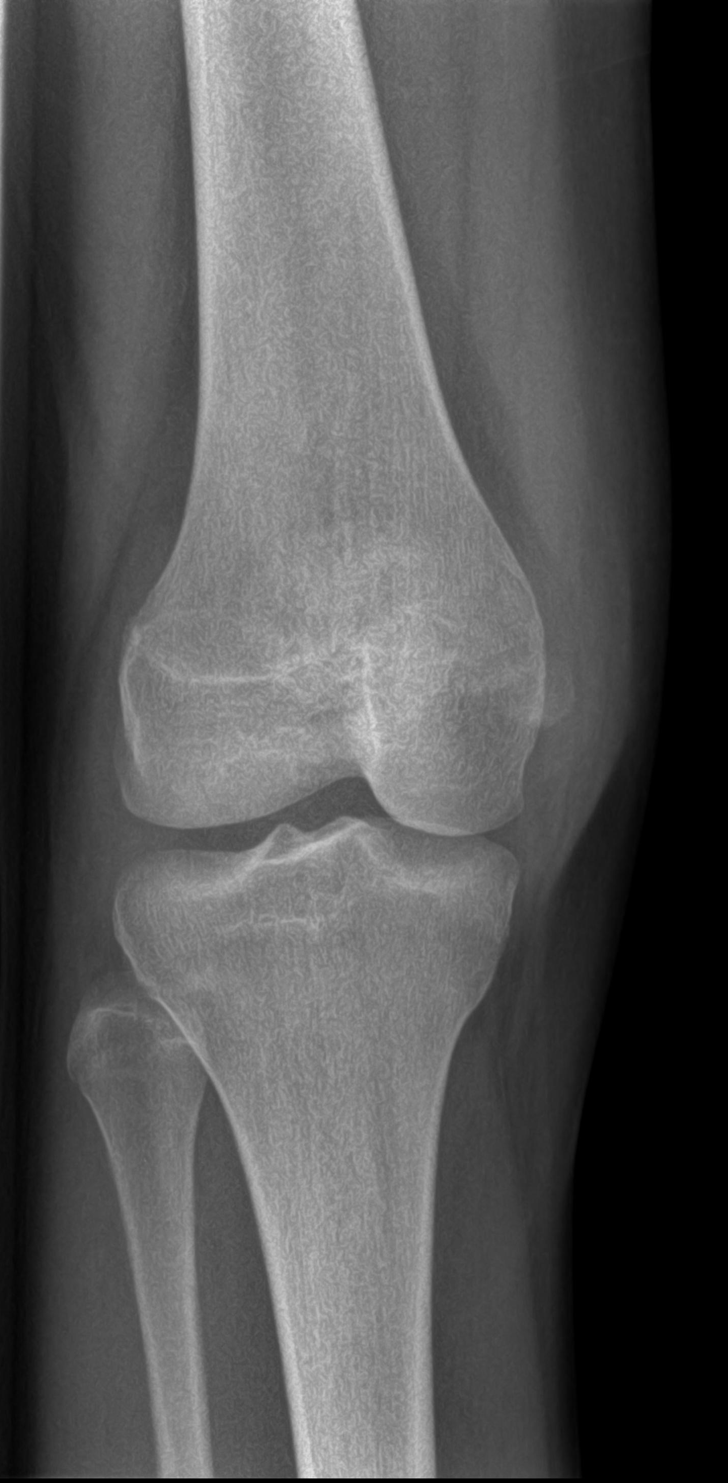 Patella fracture-dislocation | Image | Radiopaedia.org