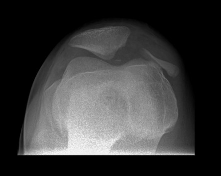 Patellar fracture | Radiology Reference Article | Radiopaedia.org