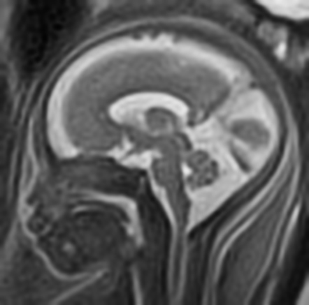 Fetal Brain Mri