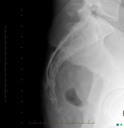 Sacrum | Radiology Reference Article | Radiopaedia.org