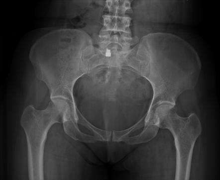 Calcific Tendinitis Of Rectus Femoris Tendon Radiology Case