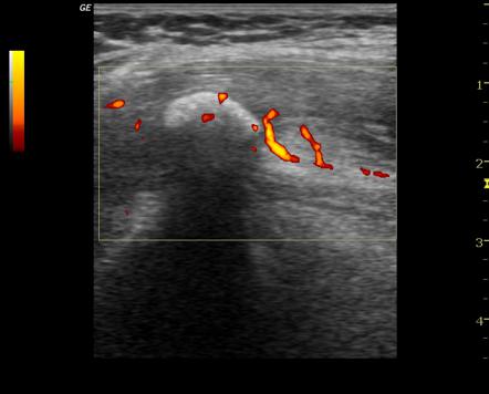 Calcific Tendinitis Of Rectus Femoris Tendon | Image | Radiopaedia.org