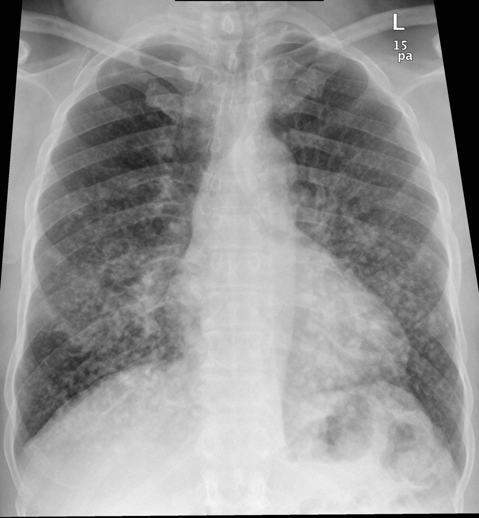 Viva Practice: Chest X-ray | Radiopaedia.org