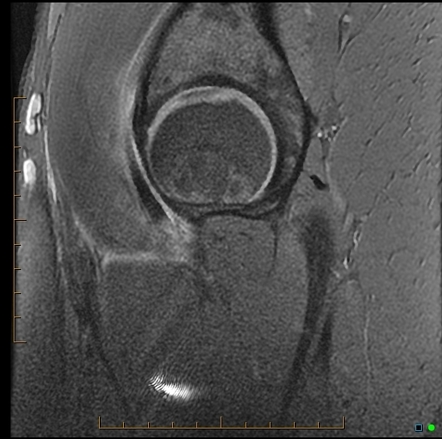 Iliopsoas tendinopathy - snapping tendon | Image | Radiopaedia.org