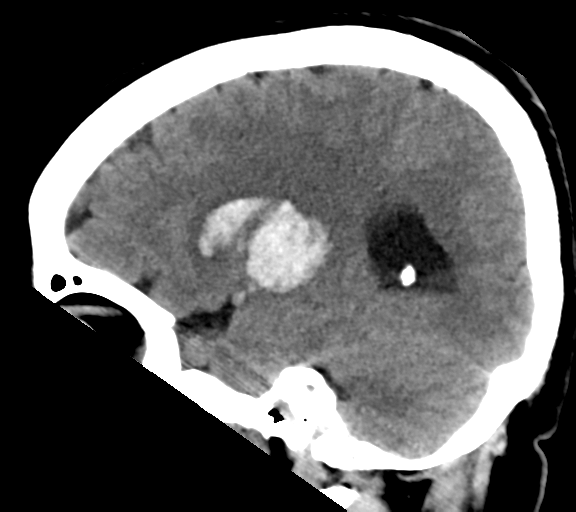 Basal ganglia hemorrhage | Image | Radiopaedia.org