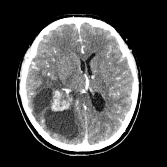 Pilocytic Astrocytoma 