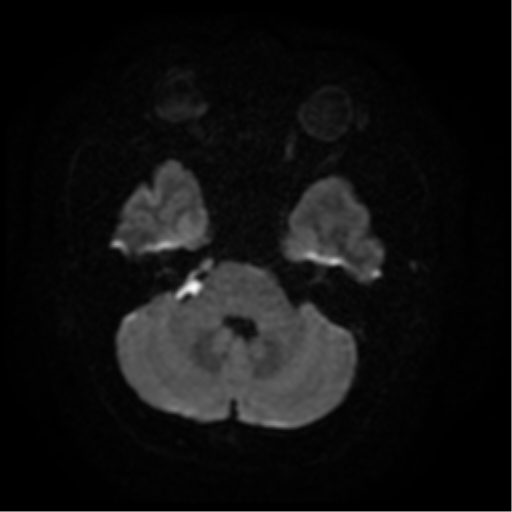 Cerebellopontine Angle Epidermoid Cyst Image 7092