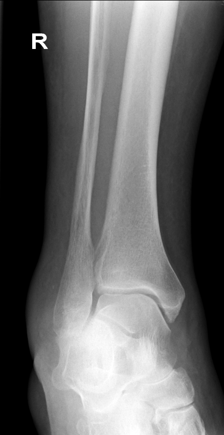 Ankle fracture - Weber A | Image | Radiopaedia.org