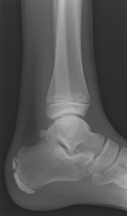 Superior peroneal retinaculum injury | Image | Radiopaedia.org