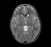 Leigh syndrome | Radiology Reference Article | Radiopaedia.org