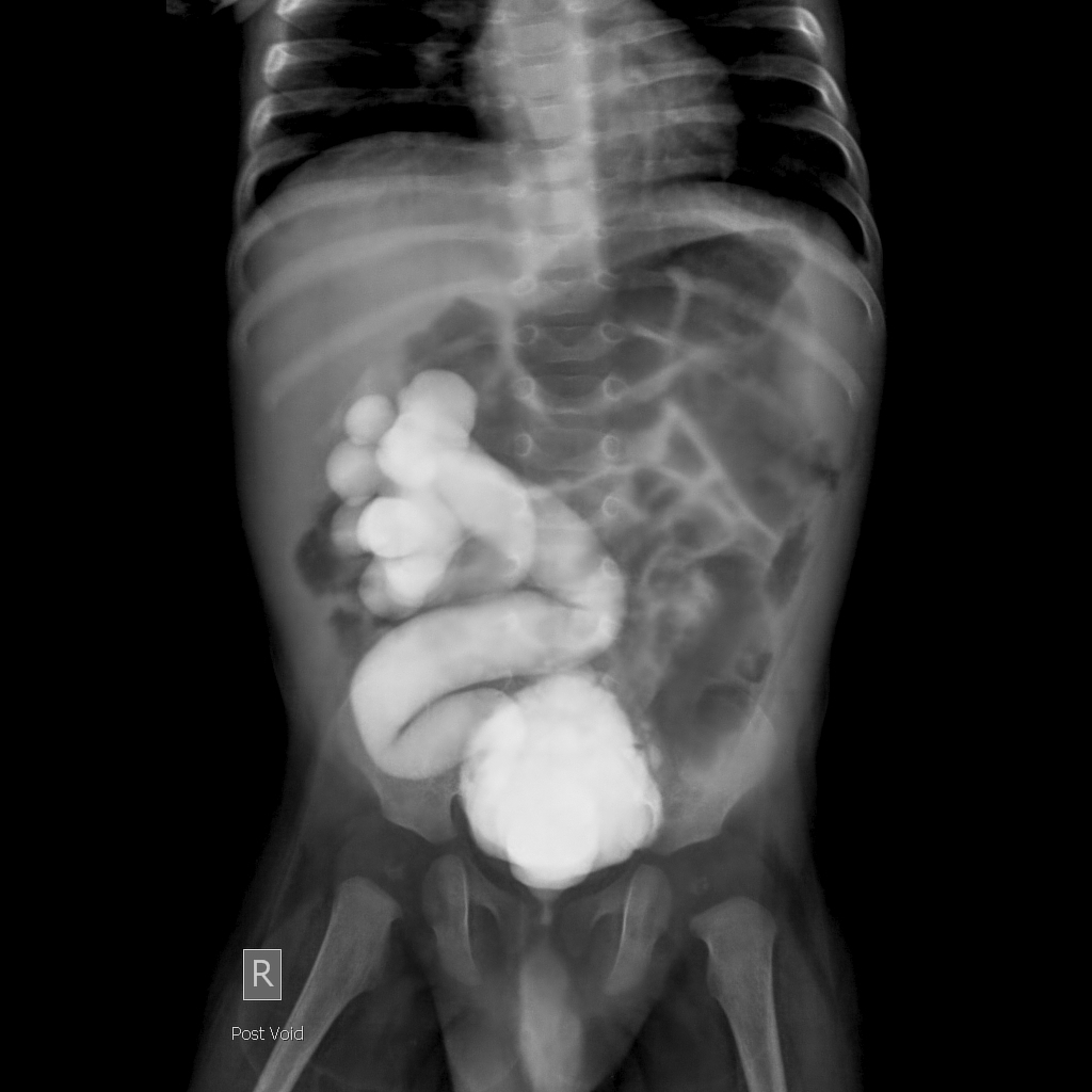 Posterior Urethral Valve Radiology Case Radiopaedia Org