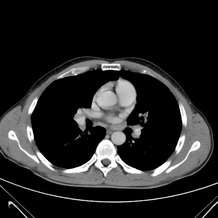 Pulmonary sarcoidosis (stage II) | Image | Radiopaedia.org