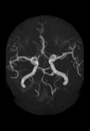 Persistent trigeminal artery | Radiology Case | Radiopaedia.org