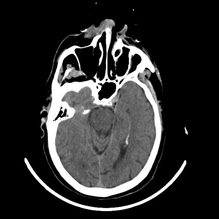 Pontine infarction and secondary Wallerian degeneration of the middle ...