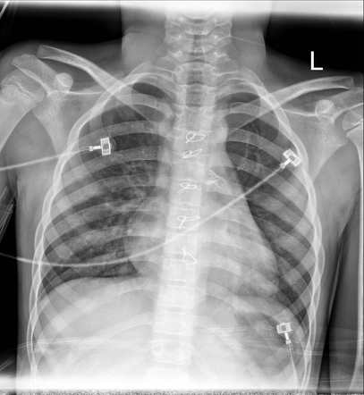 Congenital pulmonary stenosis | Radiology Reference Article ...