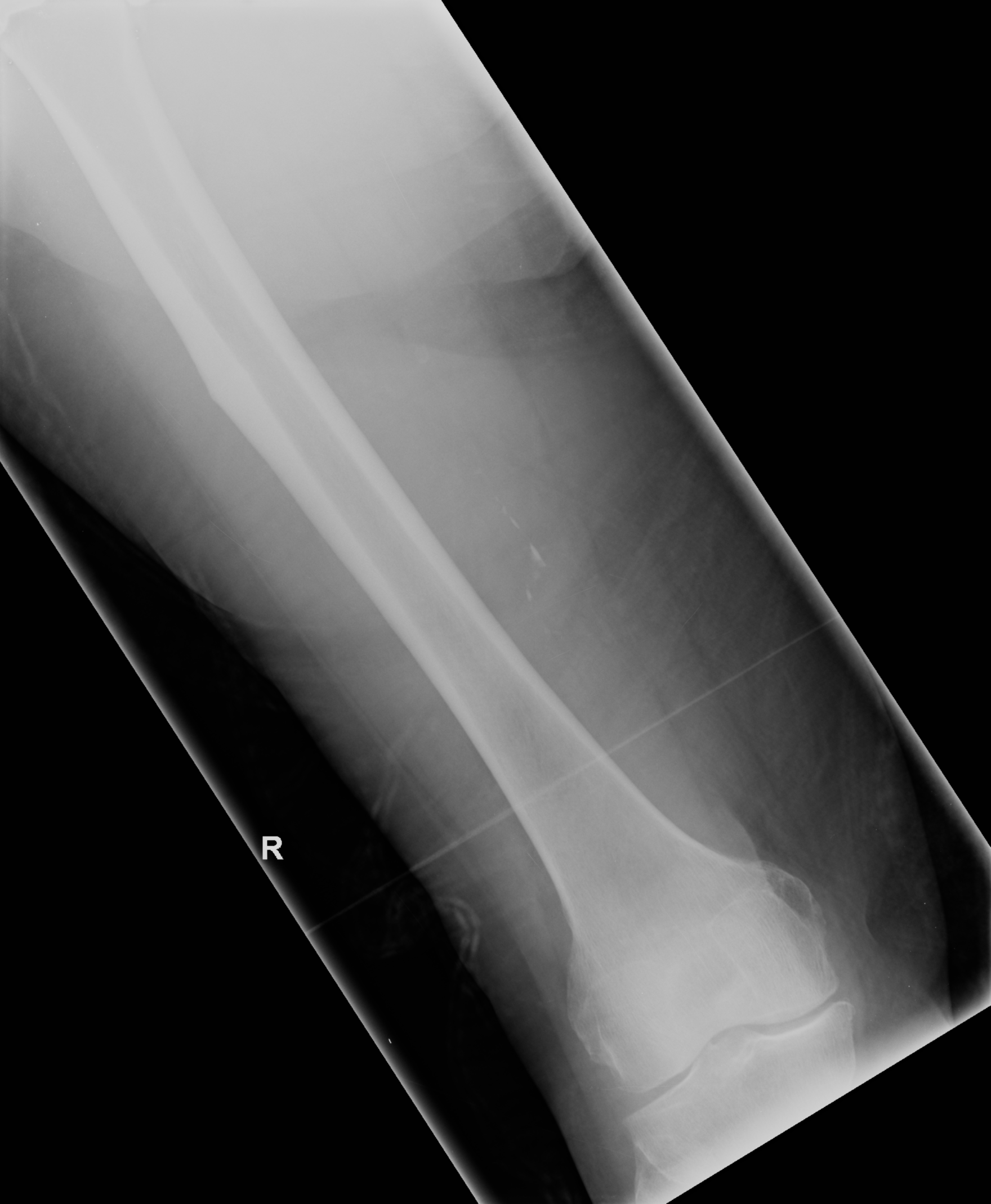 Bisphosphonate Related Atypical Femoral Fracture Image