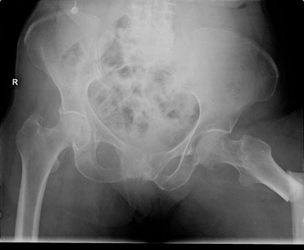 Bisphosphonate-related atypical femoral fracture | Radiology Case ...