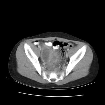 Pelvic abscess | Radiology Case | Radiopaedia.org