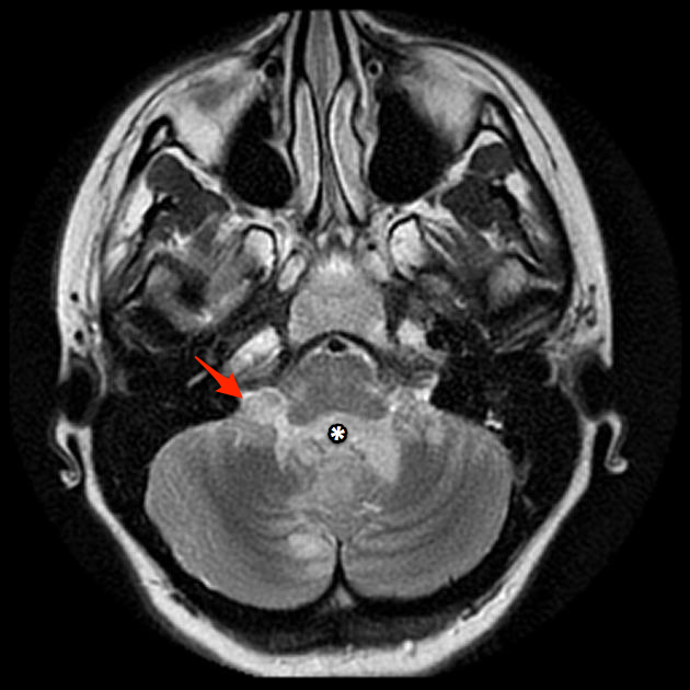 Medulloblastoma | Image | Radiopaedia.org