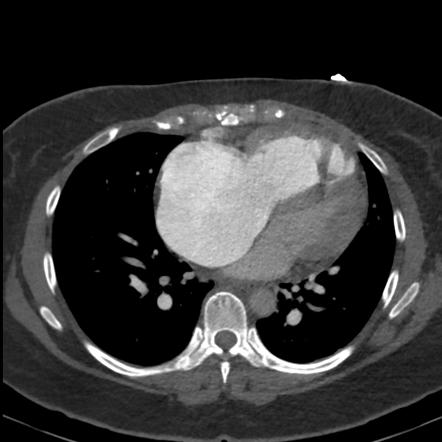 Severe pulmonary arterial hypertension | Image | Radiopaedia.org