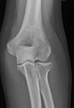 Radial head fracture | Radiology Case | Radiopaedia.org