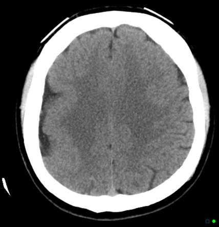 Cortical dysplasia | Radiology Case | Radiopaedia.org